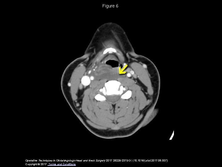 Figure 6 Operative Techniques in Otolaryngology-Head and Neck Surgery 2017 28229 -237 DOI: (10.