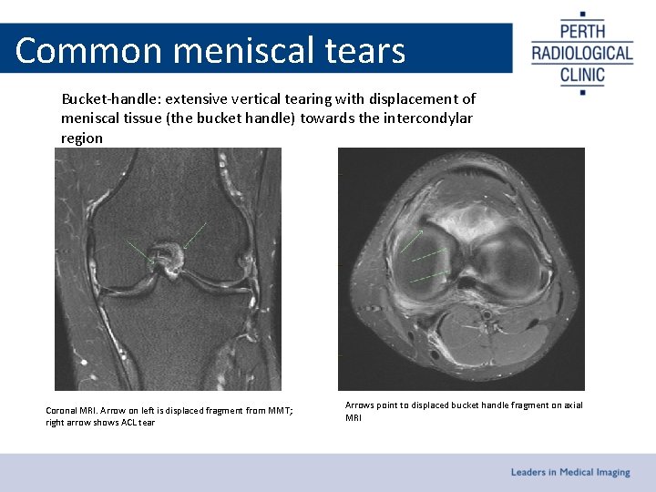Common meniscal tears Bucket-handle: extensive vertical tearing with displacement of meniscal tissue (the bucket