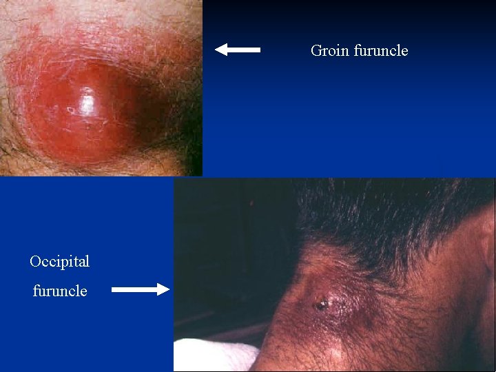 Groin furuncle Occipital furuncle 