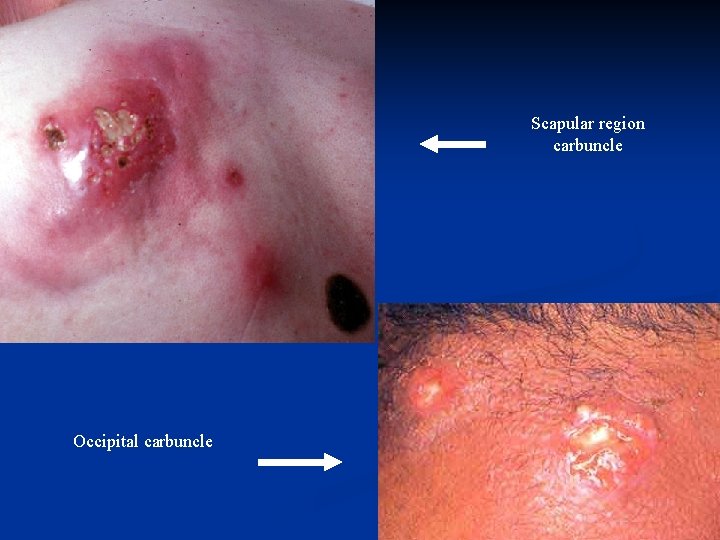 Scapular region carbuncle Occipital carbuncle 