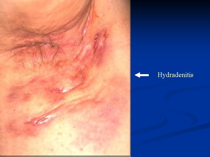 Hydradenitis 