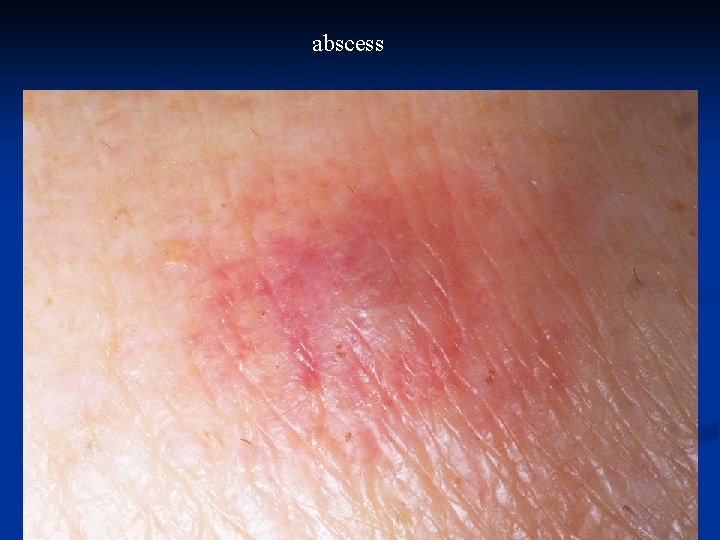 abscess 