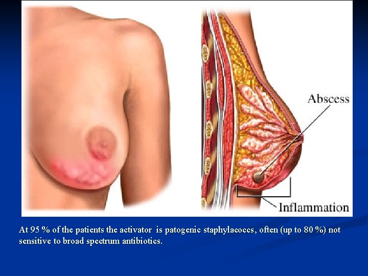 At 95 % of the patients the activator is patogenic staphylacoccs, often (up to