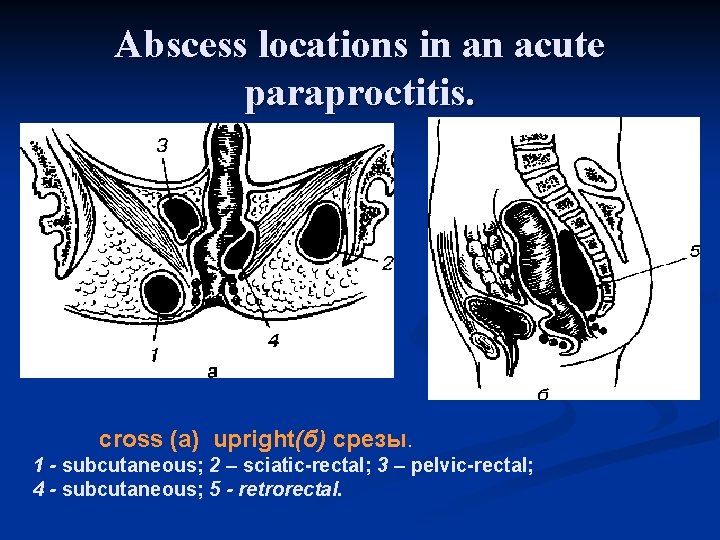 Abscess locations in an acute paraproctitis. cross (а) upright(б) срезы. 1 - subcutaneous; 2