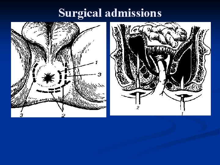 Surgical admissions 
