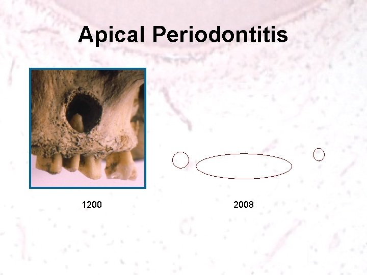 Apical Periodontitis 1200 2008 