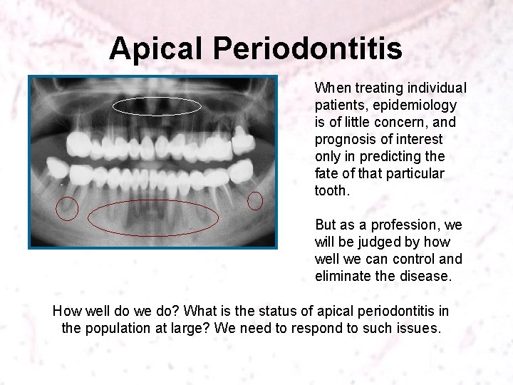 Apical Periodontitis When treating individual patients, epidemiology is of little concern, and prognosis of