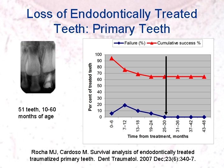 Loss of Endodontically Treated Teeth: Primary Teeth 51 teeth, 10 -60 months of age