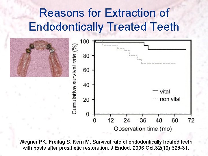 Reasons for Extraction of Endodontically Treated Teeth Wegner PK, Freitag S, Kern M. Survival