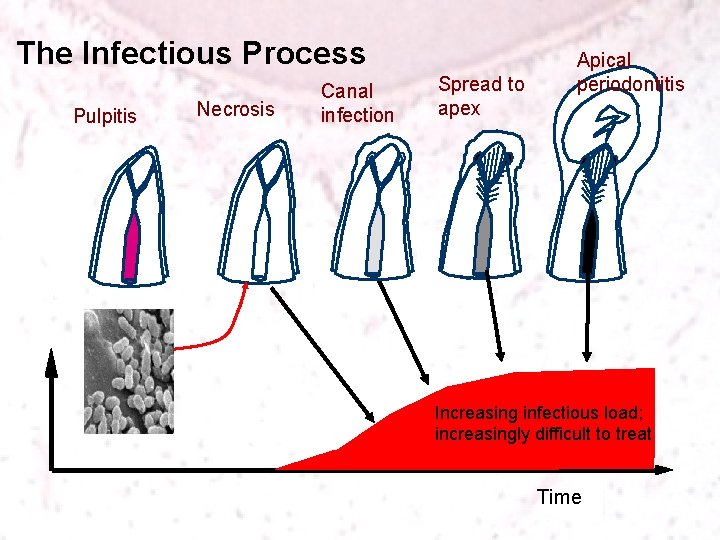 The Infectious Process Pulpitis Necrosis Canal infection Spread to apex Apical periodontitis Increasing infectious