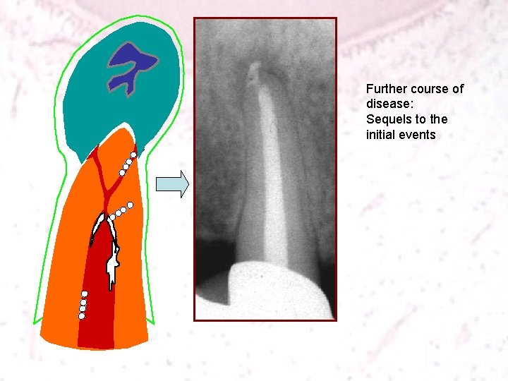 Further course of disease: Sequels to the initial events 