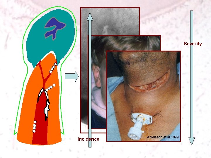 Severity Incidence Adielsson et al 1999 
