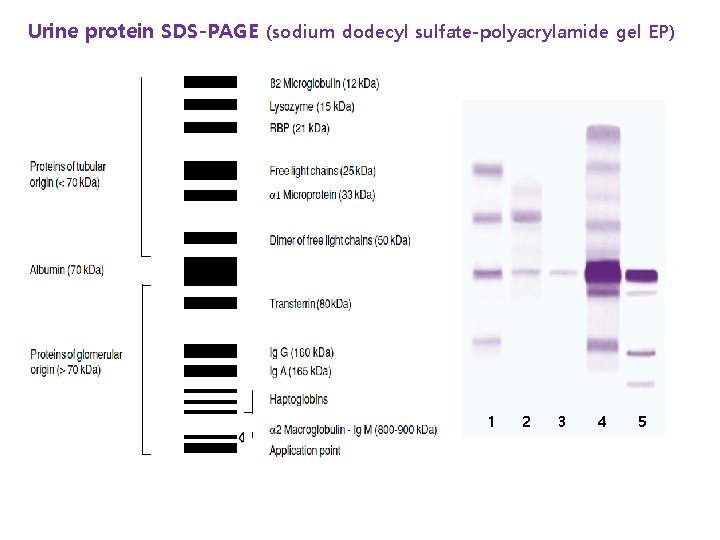 Urine protein SDS-PAGE (sodium dodecyl sulfate-polyacrylamide gel EP) 1 2 3 4 5 