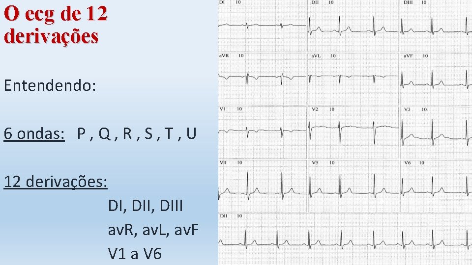 O ecg de 12 derivações Entendendo: 6 ondas: P , Q , R ,