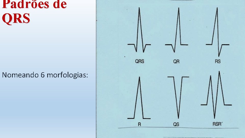Padrões de QRS Nomeando 6 morfologias: 
