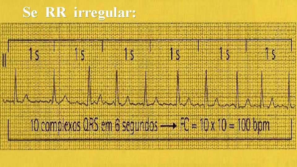 Se RR irregular: 