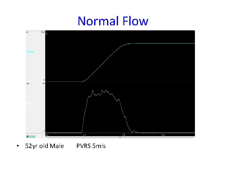 Normal Flow • 52 yr old Male PVRS 5 mls 