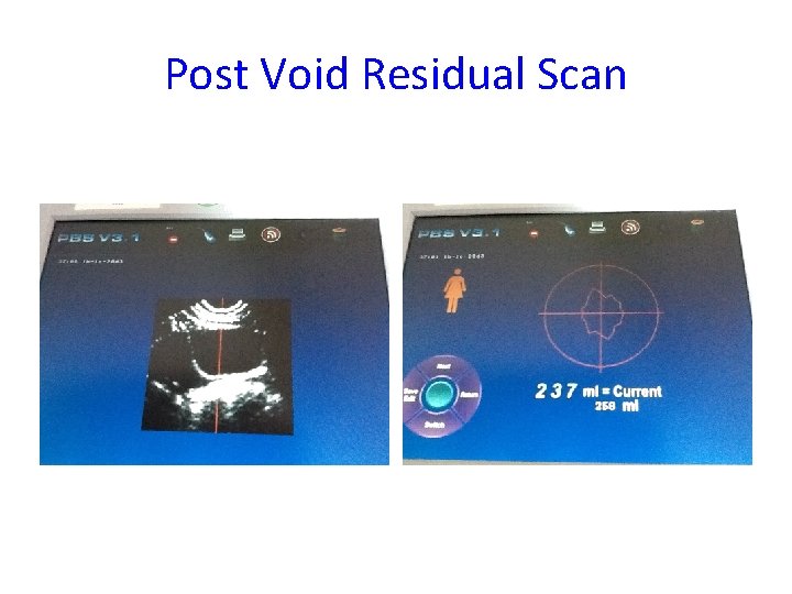 Post Void Residual Scan 