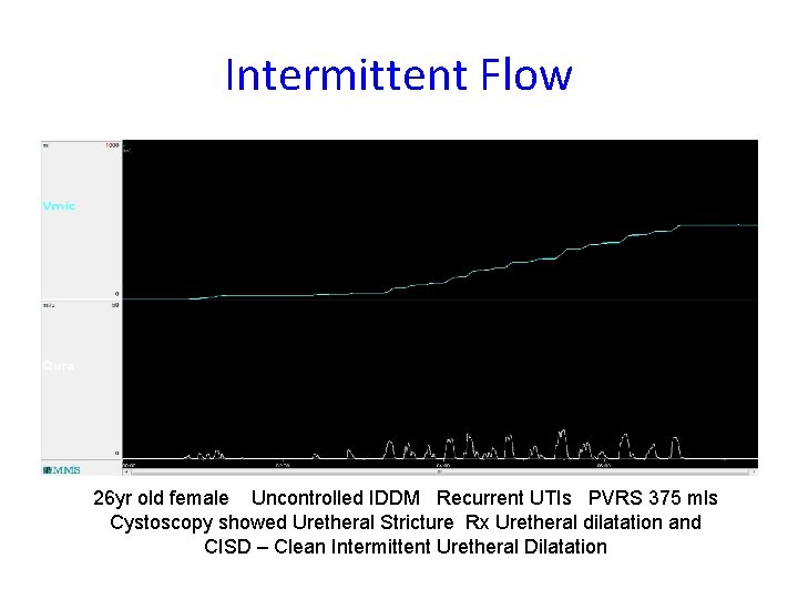 Intermittent Flow 26 yr old female Uncontrolled IDDM Recurrent UTIs PVRS 375 mls Cystoscopy