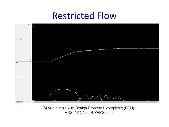 Restricted Flow 74 yr old male with Benign Prostate Hyperplasia (BPH) IPSS -18 QOL