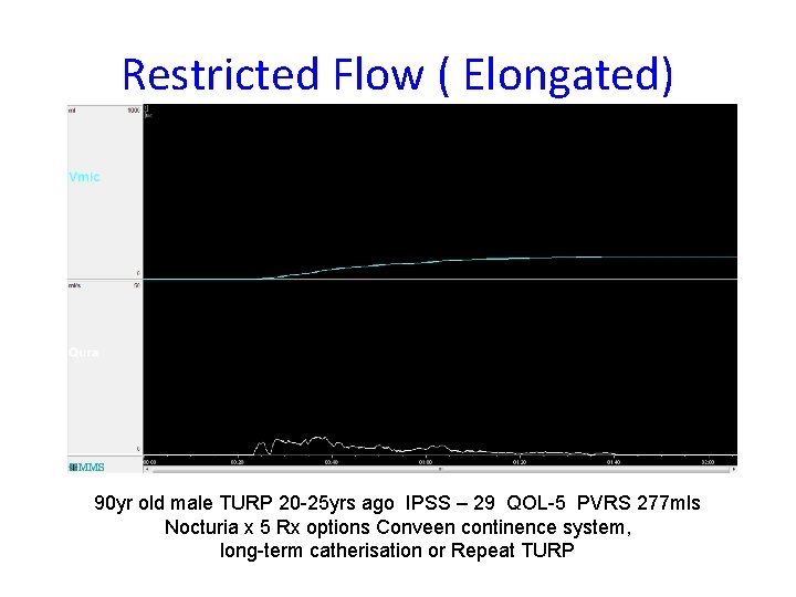 Restricted Flow ( Elongated) 90 yr old male TURP 20 -25 yrs ago IPSS