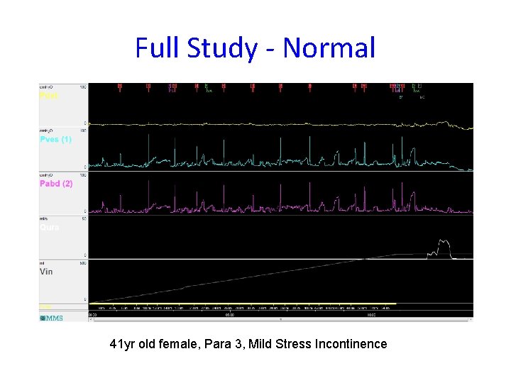 Full Study - Normal 41 yr old female, Para 3, Mild Stress Incontinence 