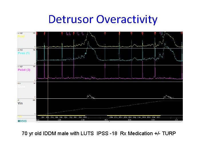 Detrusor Overactivity 70 yr old IDDM male with LUTS IPSS -18 Rx Medication +/-