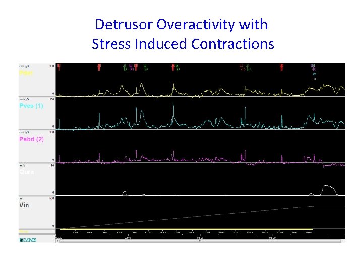 Detrusor Overactivity with Stress Induced Contractions 39 yrs old Female with Mixed Incontinence 