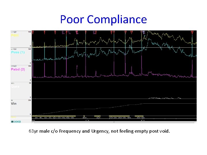Poor Compliance 63 yr male c/o Frequency and Urgency, not feeling empty post void.