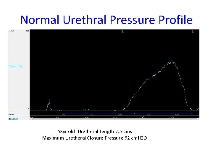 Normal Urethral Pressure Profile 53 yr old Uretheral Length 2. 5 cms Maximum Uretheral