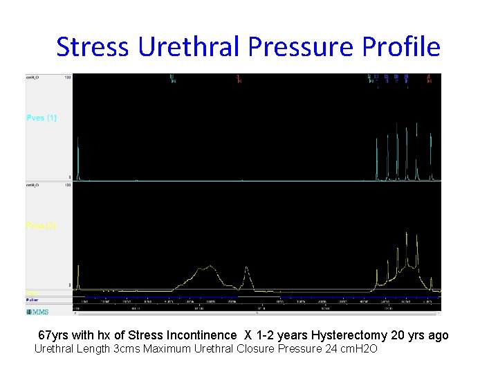 Stress Urethral Pressure Profile 67 yrs with hx of Stress Incontinence X 1 -2