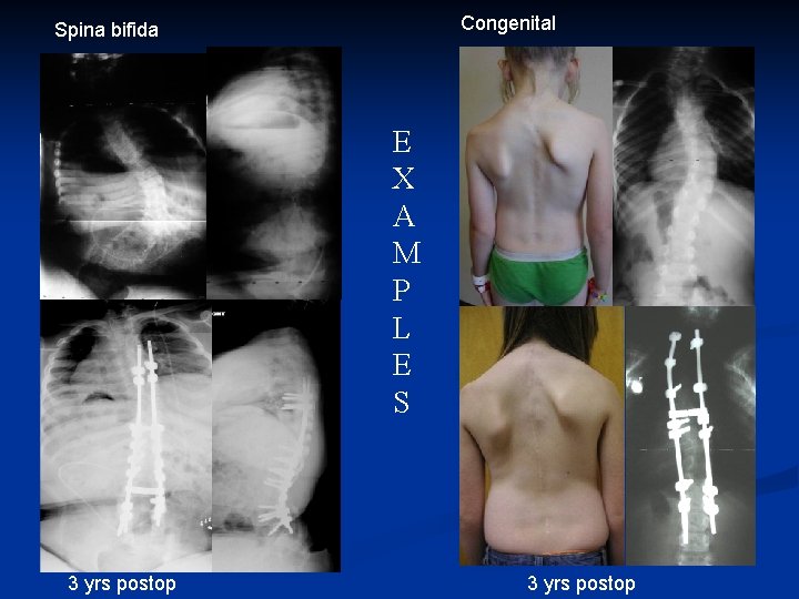 Congenital Spina bifida E X A M P L E S 3 yrs postop