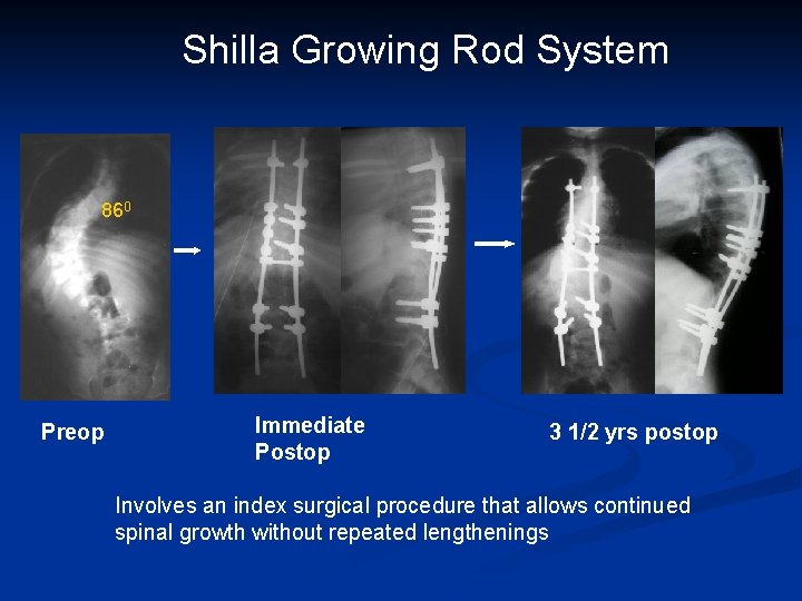 Shilla Growing Rod System 860 Preop Immediate Postop 3 1/2 yrs postop Involves an