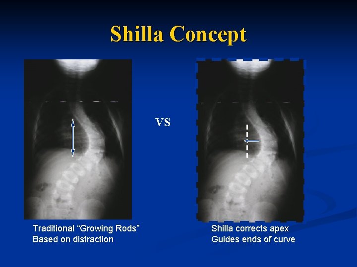 Shilla Concept VS Traditional “Growing Rods” Based on distraction Shilla corrects apex Guides ends