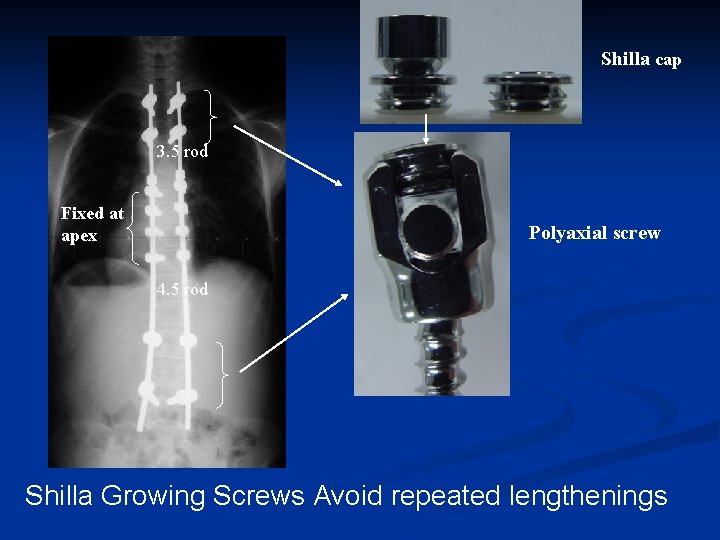 Shilla cap 3. 5 rod Fixed at apex Polyaxial screw 4. 5 rod Shilla