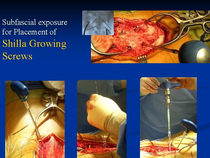 Subfascial exposure for Placement of Shilla Growing Screws 