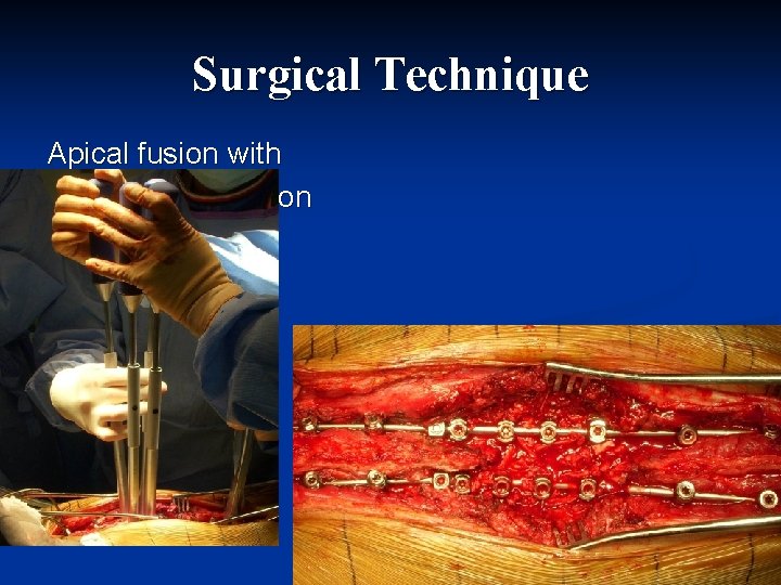 Surgical Technique Apical fusion with complete correction In all planes 