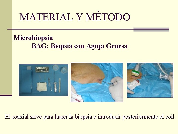 MATERIAL Y MÉTODO Microbiopsia BAG: Biopsia con Aguja Gruesa El coaxial sirve para hacer