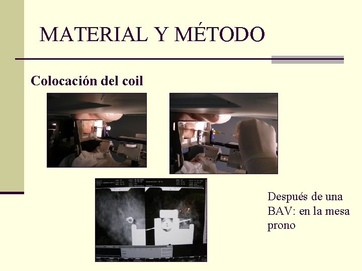 MATERIAL Y MÉTODO Colocación del coil Después de una BAV: en la mesa prono