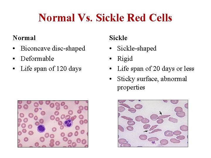 Normal Vs. Sickle Red Cells Normal Sickle • Biconcave disc-shaped • Deformable • Life Normal Vs. Sickle Red Cells Normal Sickle • Biconcave disc-shaped • Deformable • Life