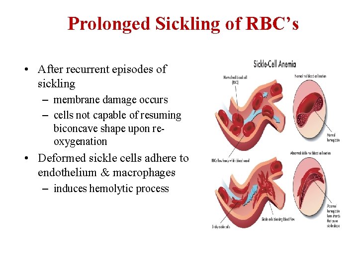 Prolonged Sickling of RBC’s • After recurrent episodes of sickling – membrane damage occurs Prolonged Sickling of RBC’s • After recurrent episodes of sickling – membrane damage occurs