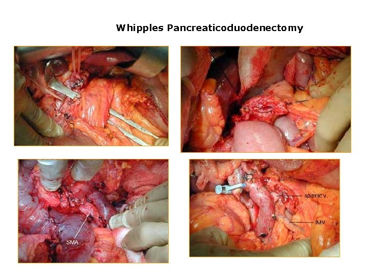 Whipples Pancreaticoduodenectomy 