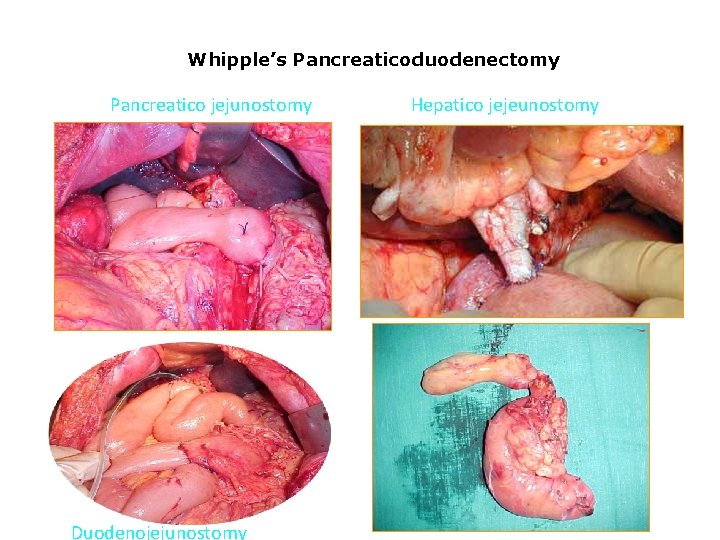 Whipple’s Pancreaticoduodenectomy Pancreatico jejunostomy Duodenojejunostomy Hepatico jejeunostomy 