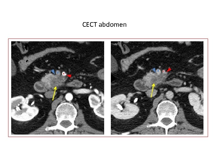 CECT abdomen 