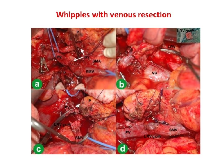 Whipples with venous resection 
