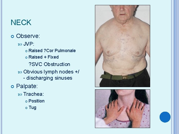 NECK Observe: JVP: Raised ? Cor Pulmonale Raised + Fixed ? SVC Obstruction Obvious