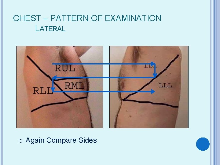 CHEST – PATTERN OF EXAMINATION LATERAL o Again Compare Sides 