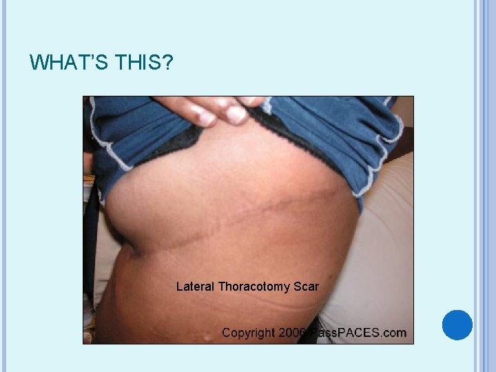 WHAT’S THIS? Lateral Thoracotomy Scar 