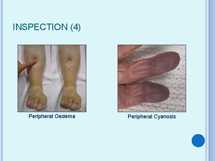 INSPECTION (4) Peripheral Oedema Peripheral Cyanosis 