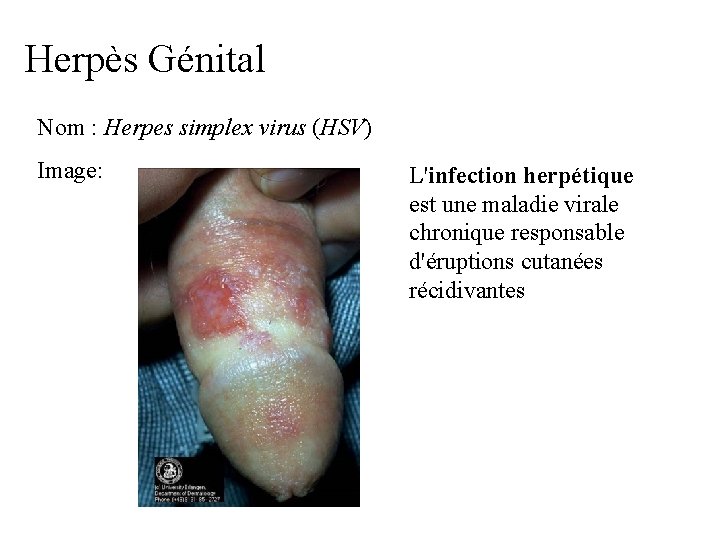 Herpès Génital Nom : Herpes simplex virus (HSV) Image: L'infection herpétique est une maladie